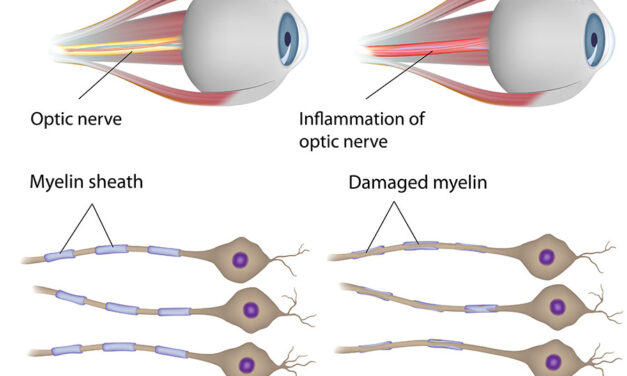 What is Neuritis, and how to naturally treat it?