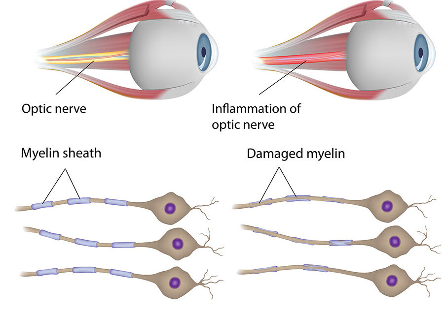 What is Neuritis, and how to naturally treat it?