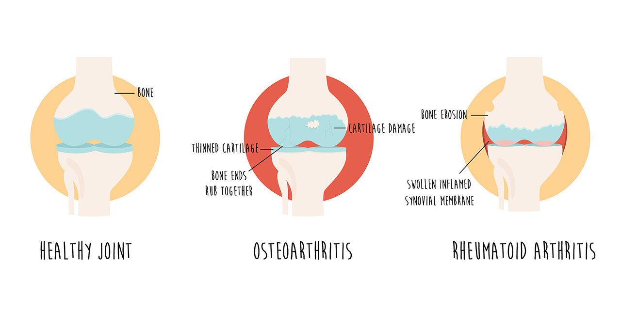 Natural Treatment for Arthritis